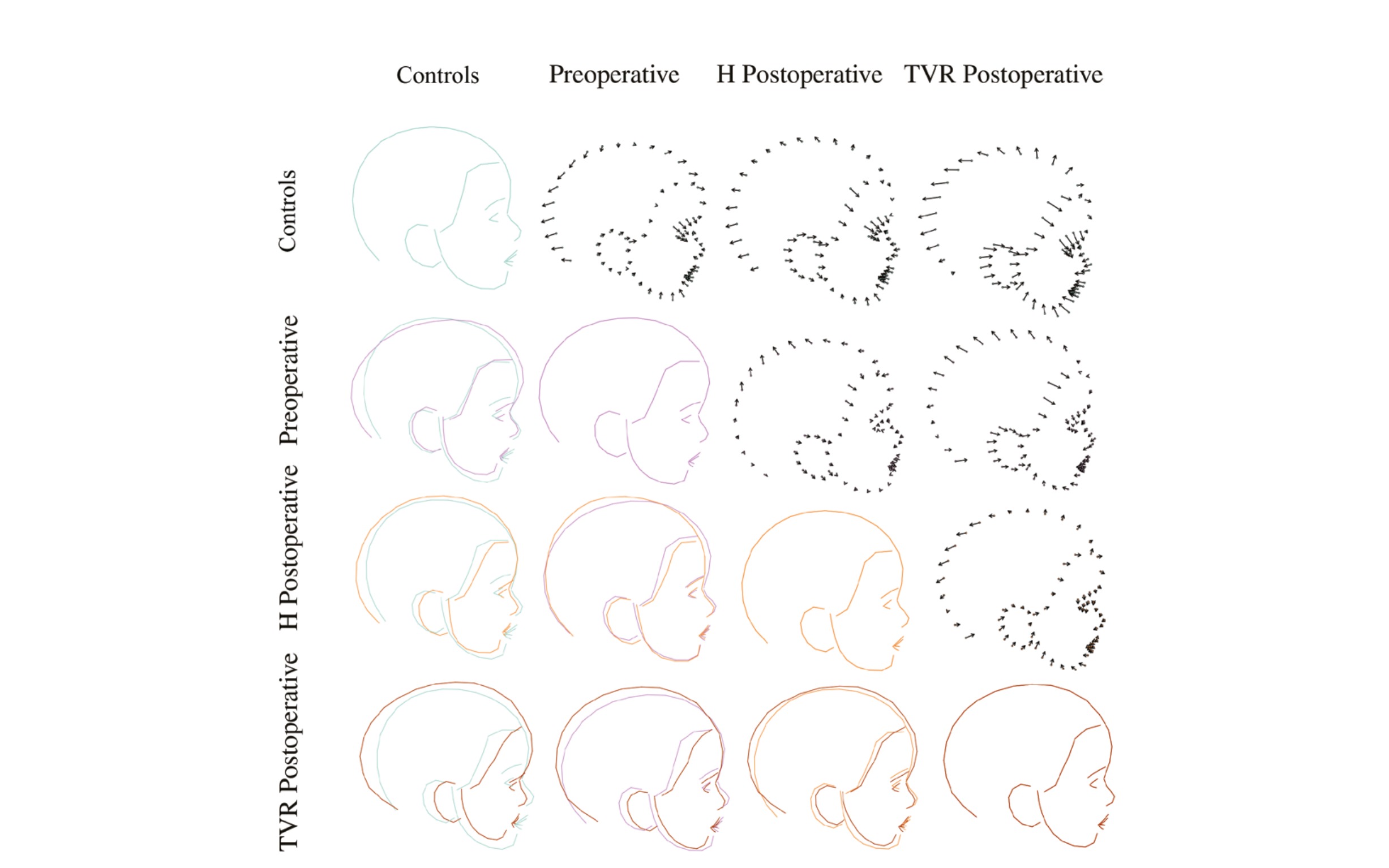 Nouvelle publication : la craniectomie en H de Renier modifie davantage la forme du crâne que le remodelage total de la voûte dans la scaphocéphalie