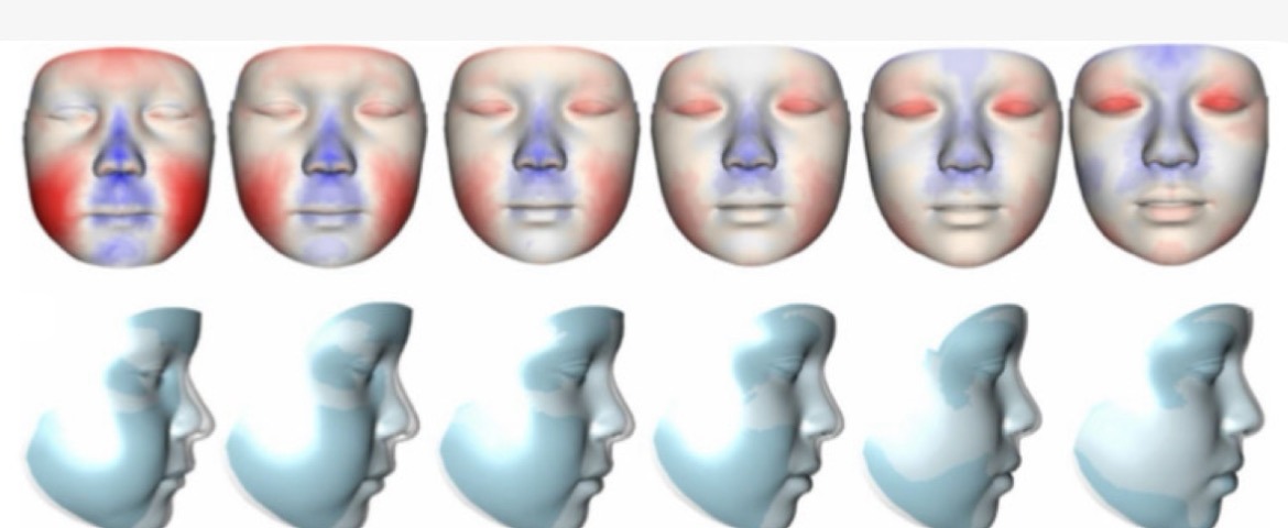 Nouvelle publication : diagnostic des maladies rares par phénotypage facial, l'exemple du syndrome de Stickler