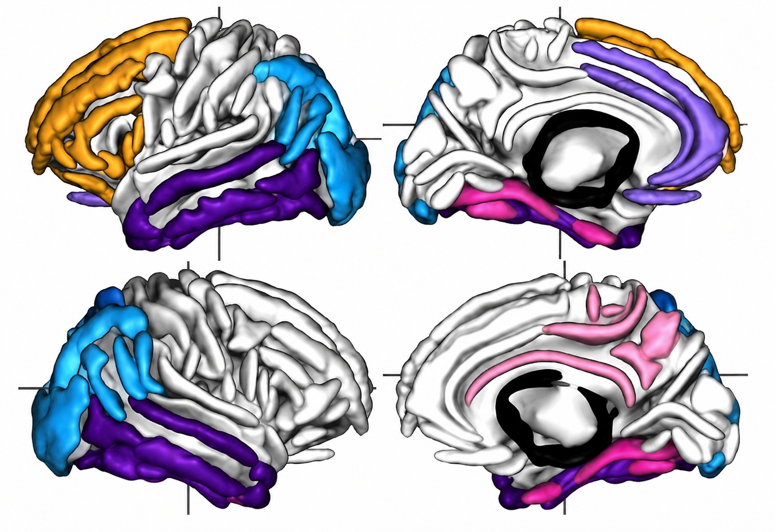 Forme du cerveau dans les craniosténoses syndromiques