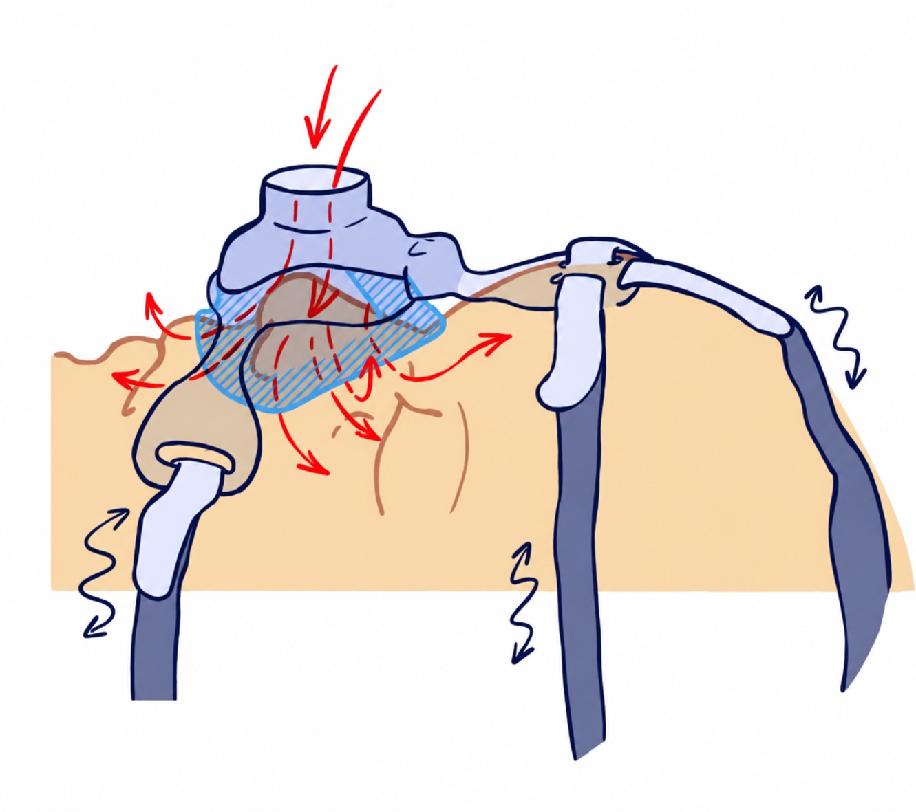 Ventilation non invasive et phénotype facial